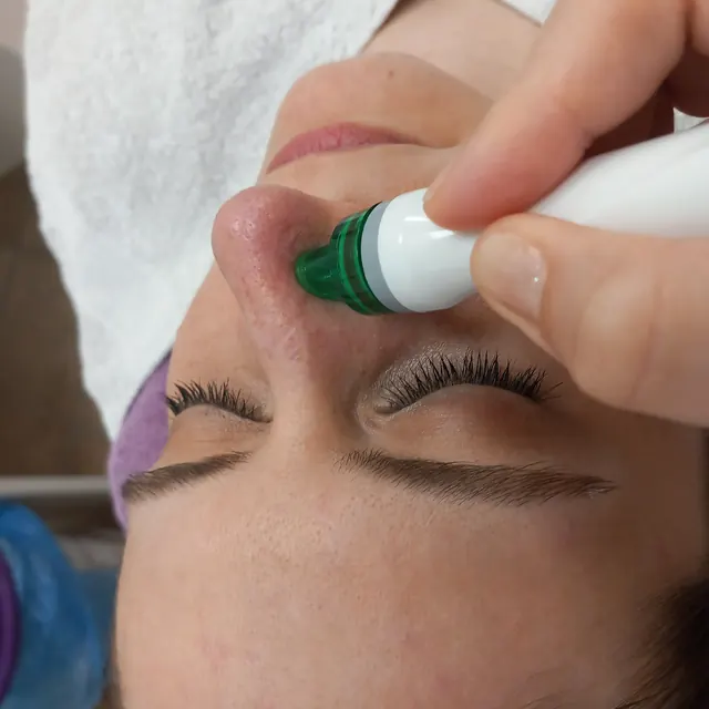 Hĺbkové čistenie pleti hlavicou Hydrafacial počas ošetrenia