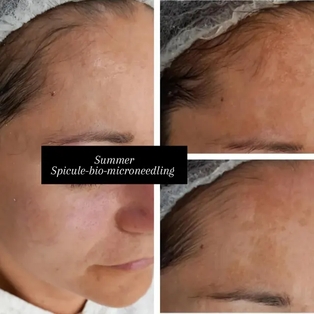 Pleť klientky pred a po ošetrení Spicule biomicroneedling
